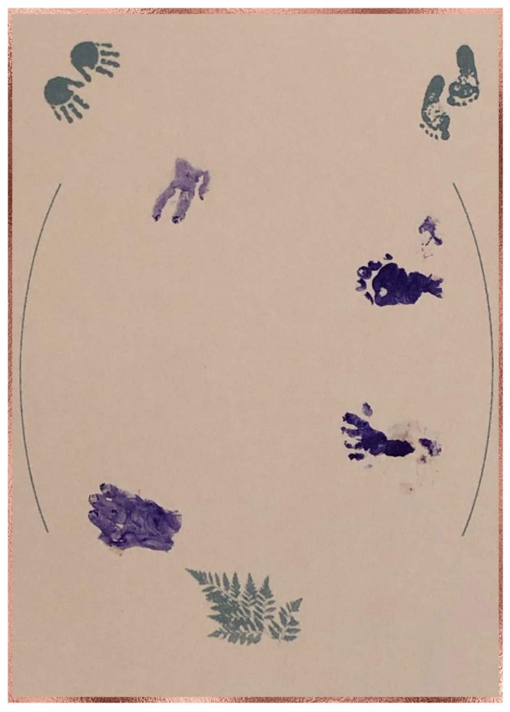 Hand and foot prints show defects from chromosomal abnormalities after pregnancy termination for medical reasons