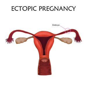 graphic-that-says-ectopic-pregnancy-showing-embryo-implanted-in-fallopian-tube-instead-of-uterus