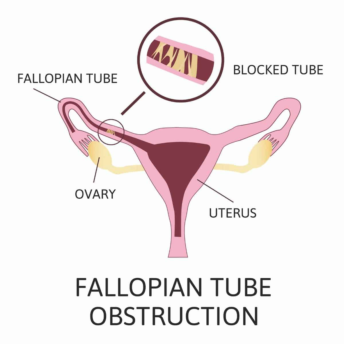 diagram of the ovaries, uterus, and fallopian tubes demonstrating a blocked tube