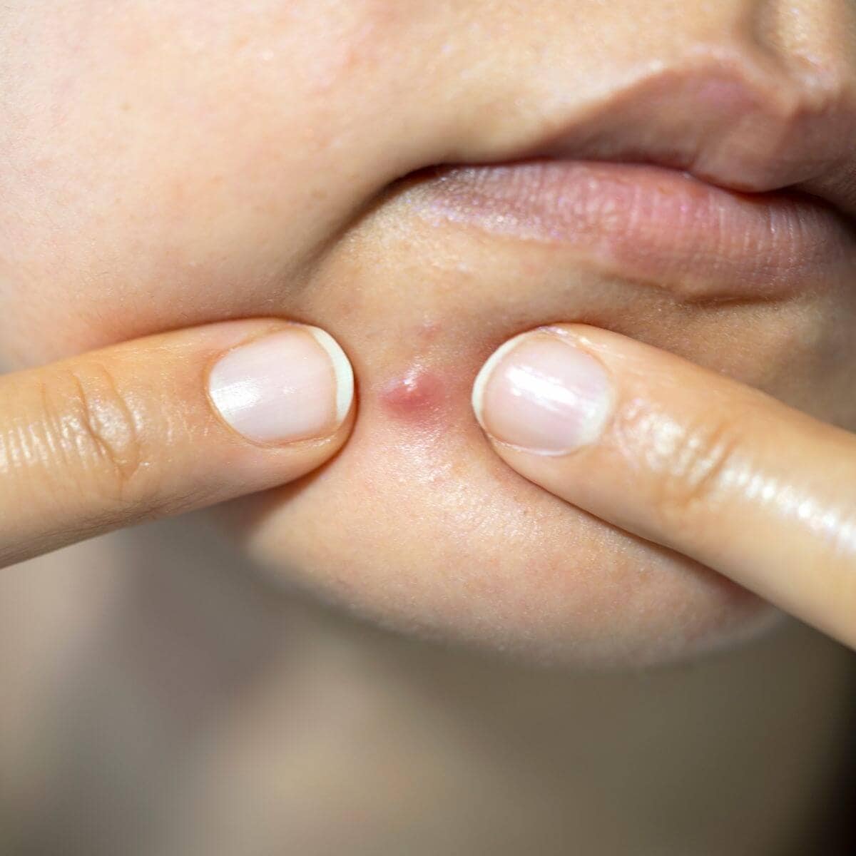 Woman with pimple between two fingers like she's going to squeeze it.