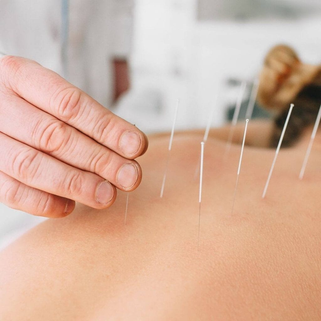 Woman laying on a table with acupuncture needles being placed in her back by a male doctor.