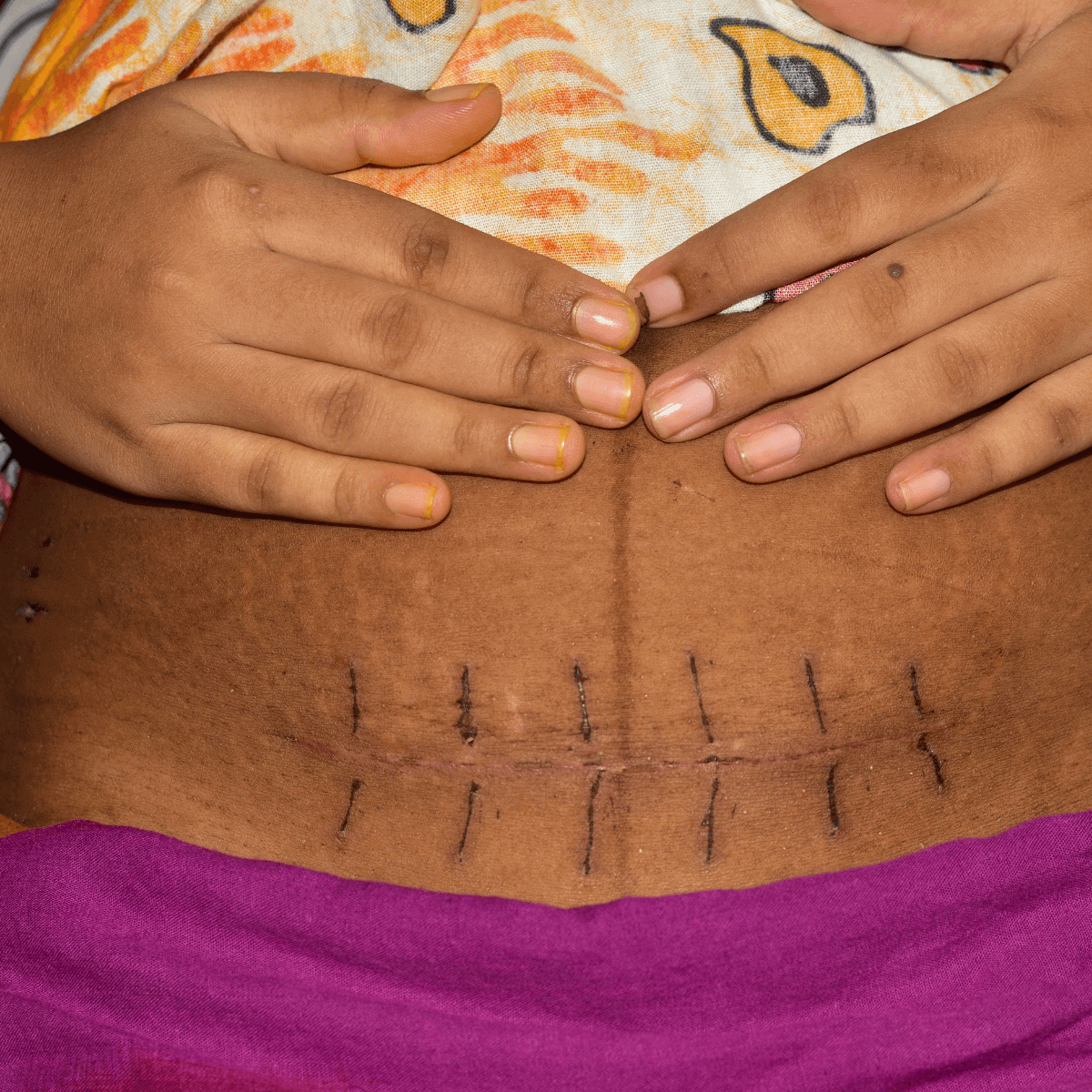 This image shows a person of color's midsection with a linea negra down the center of her belly and a csection scar with black lines around it.